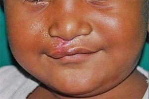 Read more about the article Research shows 32,000 children born with Cleft in Africa every year