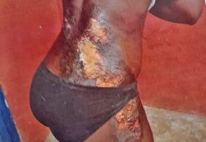 Read more about the article Mother pours hot water on daughter for taking her GH¢5.00 for food