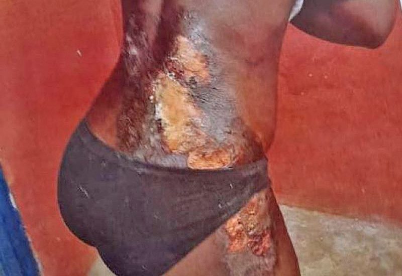 You are currently viewing Mother pours hot water on daughter for taking her GH¢5.00 for food