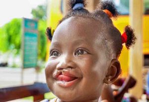 Read more about the article Restoring babies’ smiles is our calling – Operation Smile Ghana