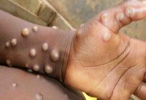 Read more about the article Monkey Pox Outbreak: Ghana records four deaths, 116 cases