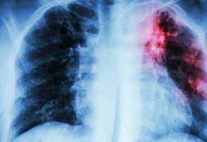 Read more about the article TB Patients to take less medicines for treatment come October 2023